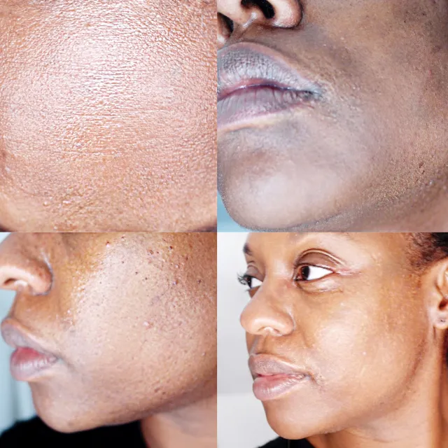 femme avec hyperpigmentation