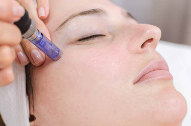 session de microneedling