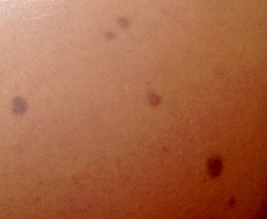 Quel est le prix pour éliminer un grain de beauté sur le visage ?