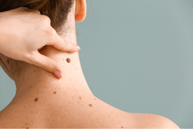 Personne de dos touchant un grain de beauté sur son épaule, multiples taches de rousseur sur la peau.