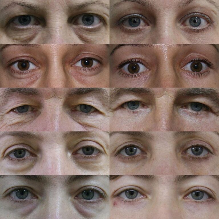 La blépharoplastie : tout ce que vous devez savoir sur cette tendance en plein essor et sur sa sécurité !