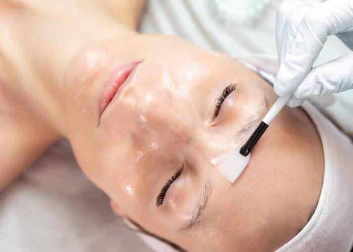 Type de peeling chimique